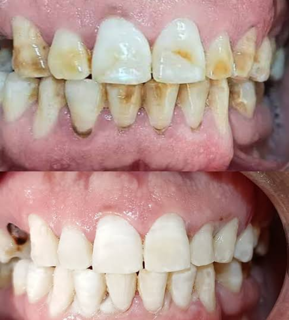 تبيض الأسنان و إزالة خط العرجون بالضمان