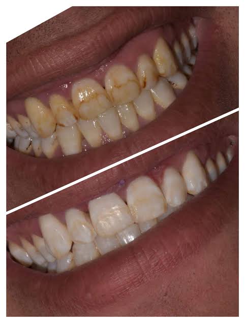 تبيض الأسنان و إزالة خط العرجون بالضمان